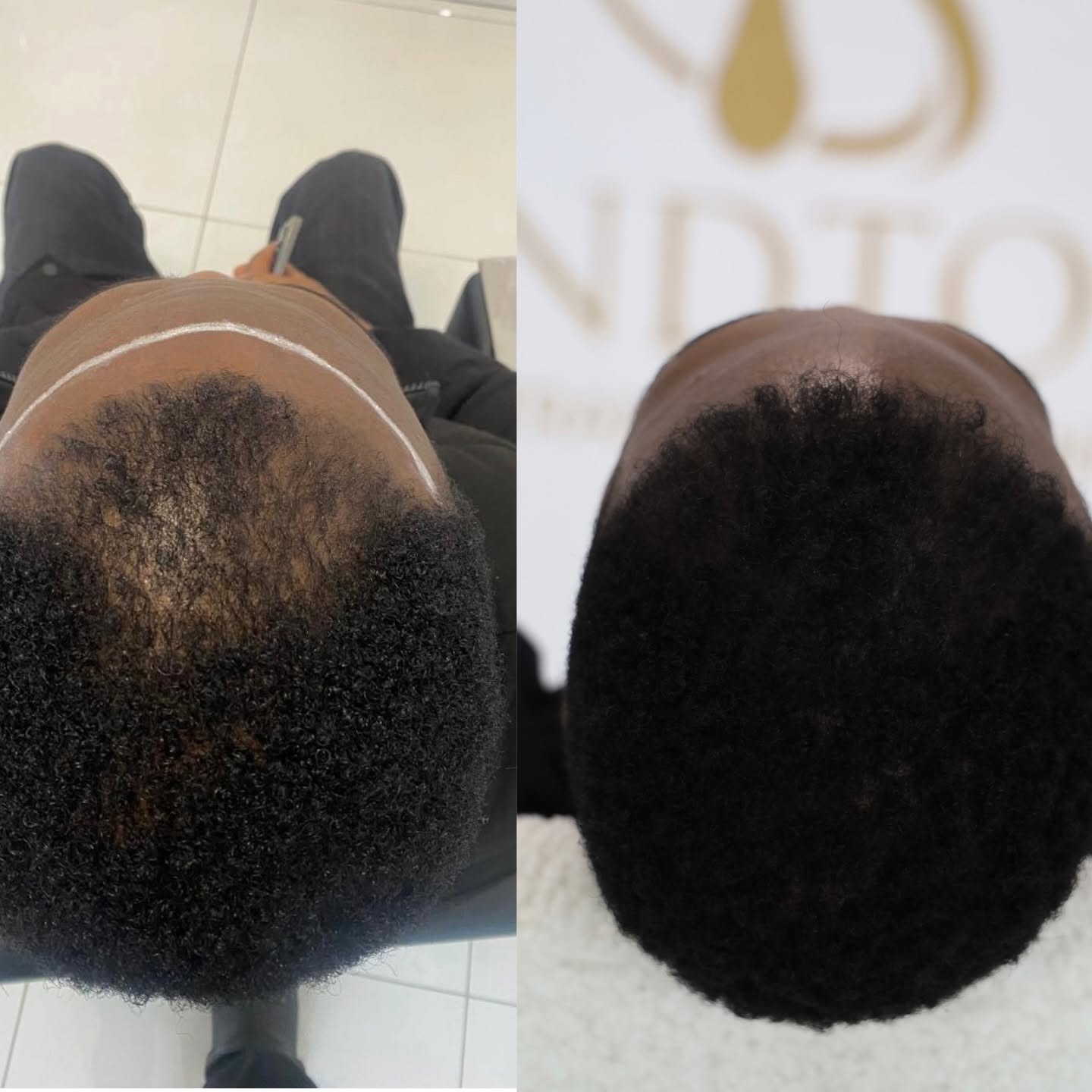 Hair Transplant Results